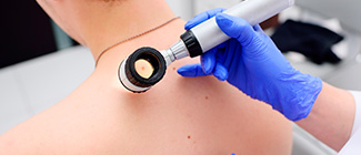 Удаление родинок Удаление родинок