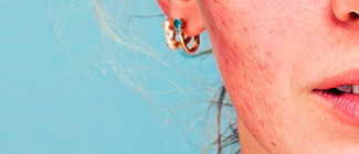 Лечение розацеа Лечение розацеа